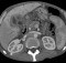 Cholangiocarcinoma - CT scan