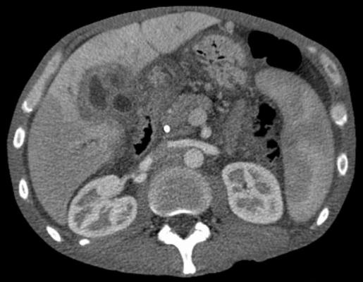 Cholangiocarcinoma - CT scan