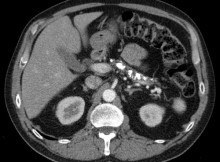 Chronic pancreatitis - CT scan