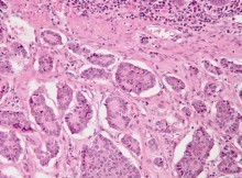 Neuroendocrine tumour - small intestine