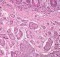 Neuroendocrine tumour - small intestine