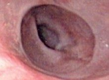 Schatzki's ring - endoscopic view