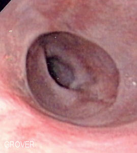 Schatzki's ring - endoscopic view