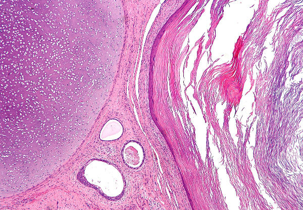 Teratoma - histology