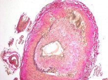 Giant cell vasculitis