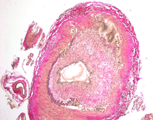 Giant cell vasculitis