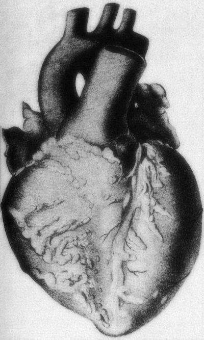 Nodular thickened coronary vessels in polyarteritis nodosa