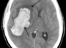 Intraparenchymal bleed with surrounding oedema- CT Scan
