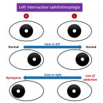 Site of lesion of internuclear ophthalmoplegia - Medicine MCQ « PG Blazer