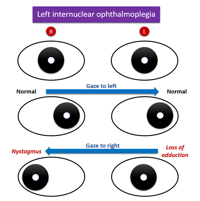 Internuclear Ophthalmoplegia